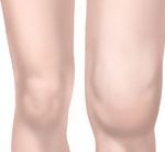 arthtitis knee CDC 2